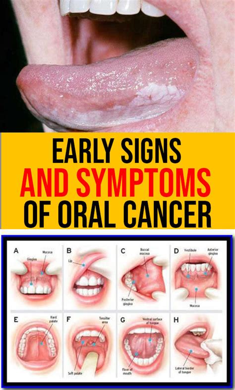 Mouth Cancer Early Warning Signs