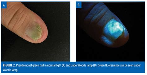 25+ Tinea Versicolor Woods Lamp - AntheaAislinn