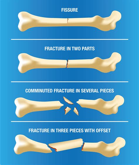 Complete Fracture Diagram