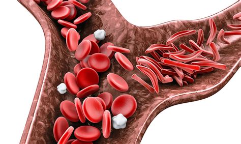 Sickle cell disease: What you should know | NIH MedlinePlus Magazine