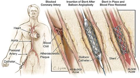 Percutaneous Coronary Intervention | Acute Coronary Syndromes | JAMA ...