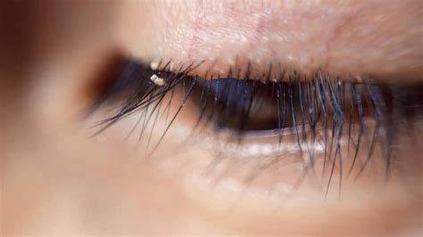 Doctors warn about dangers and spread of eyelash lice