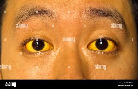 Sclera jaundice hi-res stock photography and images - Alamy