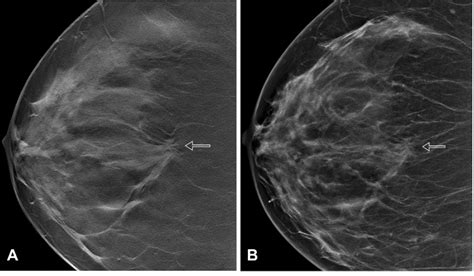 Digital Breast Tomosynthesis and Breast Density: What a New Study Reveals