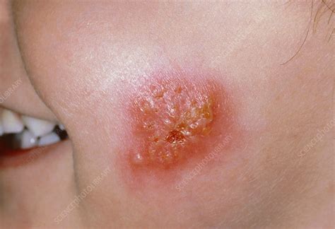 Impetigo lesion on a child's cheek - Stock Image - M180/0051 - Science ...