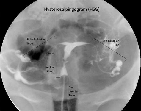 Hysterosalpingogram Test (HSG Test) | Conception Advice