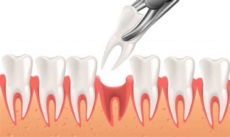 The Answers To All Your Questions On Tooth Extractions