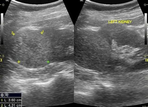 Renal Cell Carcinoma Ultrasound