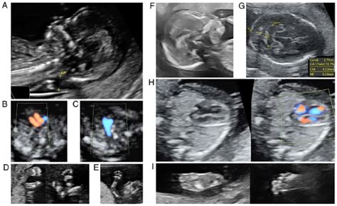 Early anomaly scan. (A) Isolated thickened nuchal translucency at 12 ...