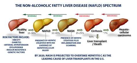 Fatty Liver Disease - Texas Liver Institute