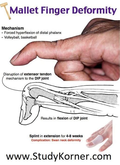 Swan Neck Deformity Mallet Finger Physical Therapy - StudyKorner ...