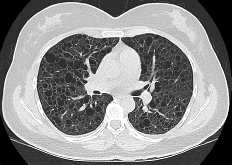 Diffuse Cystic Lung Diseases | Respiratory Care