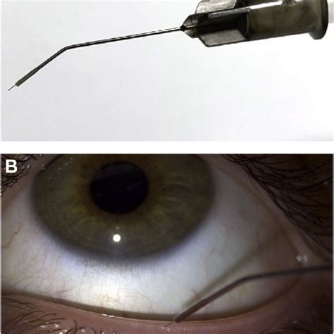 e Meibography of (A) healthy meibomian glands, (B) MGD with moderate ...