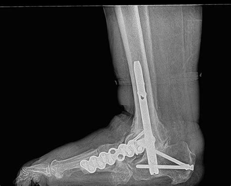 Charcot Foot Reconstruction