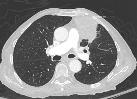 Streptococcus intermedius lung infection masquerading as malignancy ...