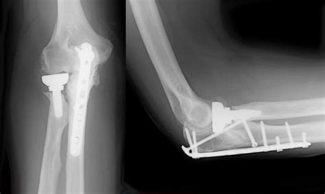 Complex Elbow Fracture Surgery | Arm Docs