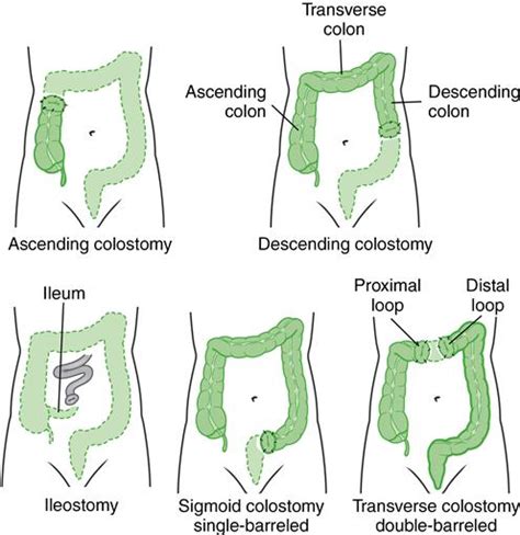 Loop Colostomy