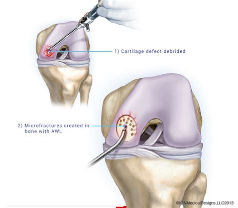 Arthroscopic Debridement and Microfracture - Joint Preservation Center