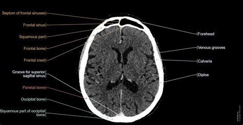 Normal Brain Ct Scan Labeled