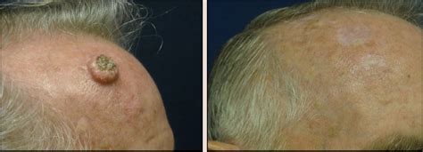 Skin Cancer Removal Before and After Pictures | Prplastic