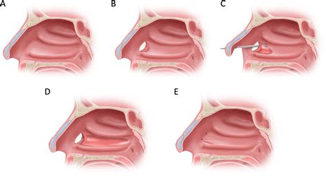 How I Do It: Inferior Turbinectomy: Modified Techniques for Submucosal ...