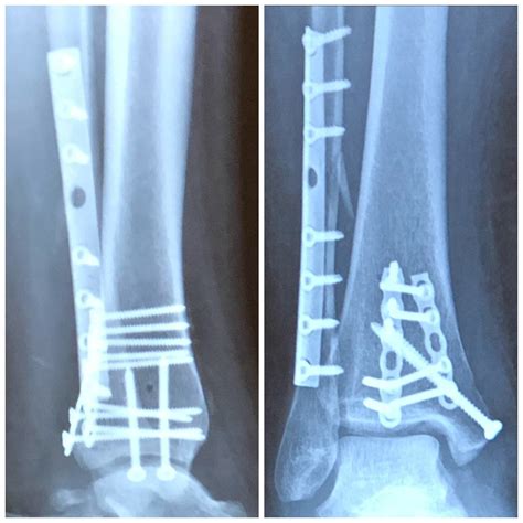 Broken Ankle Surgery Recovery After Trimalleolar Fracture - Whole ...