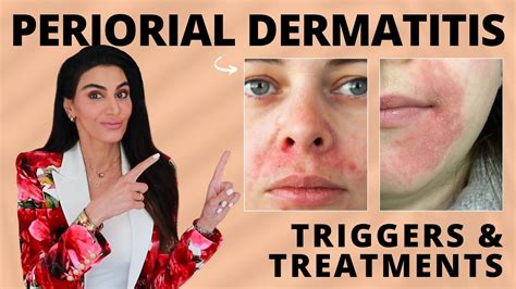 What Is Perioral Dermatitis? Symptoms, Causes, Diagnosis, pregnancy ...