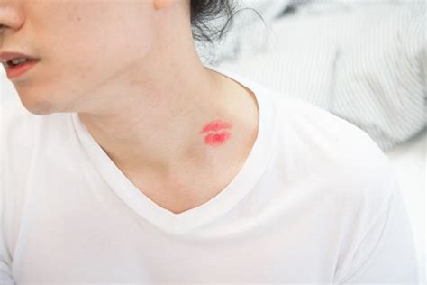 How to Get Rid of a Hickey - Facty