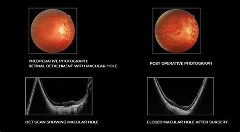 Retinal Detachment: Symptoms Archives - Neoretina Blog