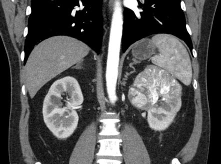 Renal Cell Carcinoma Mri