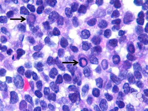 Dutcher Bodies in Lymphoplasmacytic Lymphoma 3