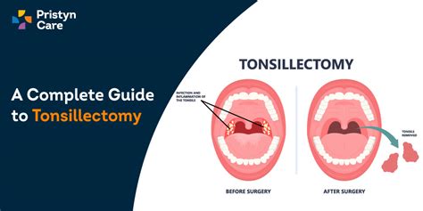 A Complete Guide to Tonsillectomy - Pristyn Care