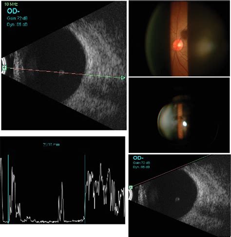 Figure 1 from A Suspected Detached Pars Plana Cyst in the Vitreous ...