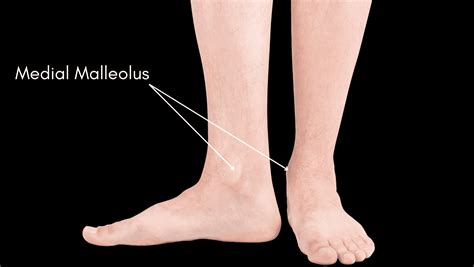 Medial Malleolus Pain: Get the answers from a Foot Specialist