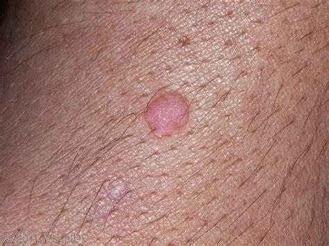 The basics of warts | Sutton Dermatology & Aesthetics Ctr