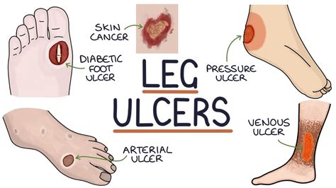 Diabetes 22, Feet Problems - Diabetes