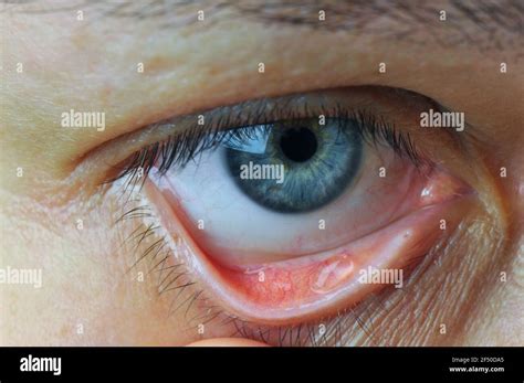 Conjunctival sac hi-res stock photography and images - Alamy