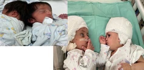 Doctors separate Siamese twins after 'massively complex' 12-hour ...