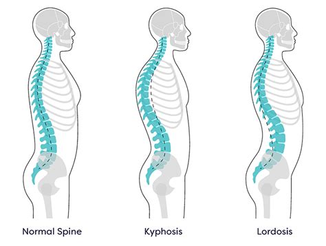 Kyphosis Treatment in NJ and NYC | Kyphosis Surgery in New Jersey