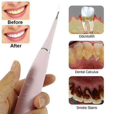 Electric Tooth Plaque Removal Calculus Plaque Removal Tool Tooth Stain ...