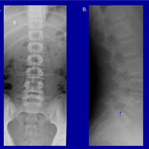 Scintigraphic findings in a patient with right L3 pars stress on planar ...