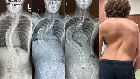 Severe Scoliosis X Ray