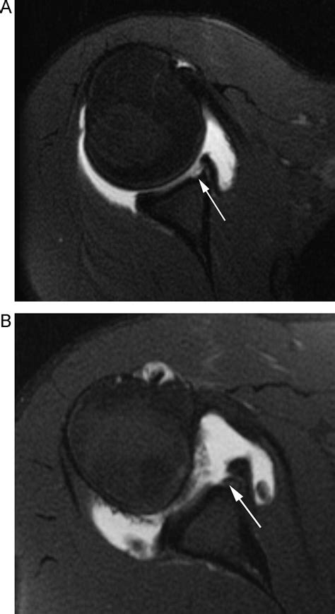 Frequency of glenoid chondral lesions on MR arthrography in patients ...