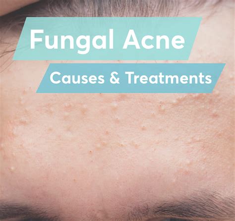 Fungal Acne On Body