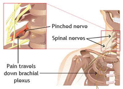 Pinched Nerve in Neck Treatment in New York City