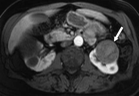 Renal Cell Carcinoma Mri