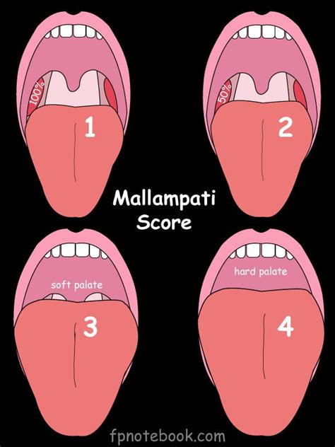 Mallampati Score | Pediatric dentistry, Patient education, Paramedic school