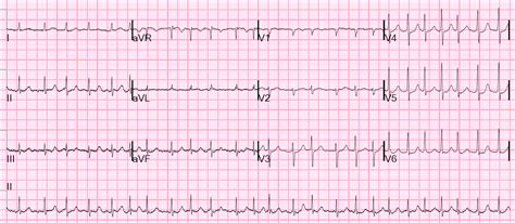 Ecg With Atrial Fibrillation