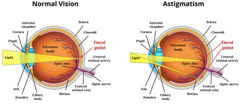 What is Astigmatism - Causes, Symptoms,Treatment