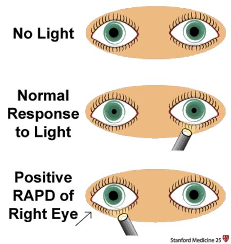 Pupil Reaction Chart